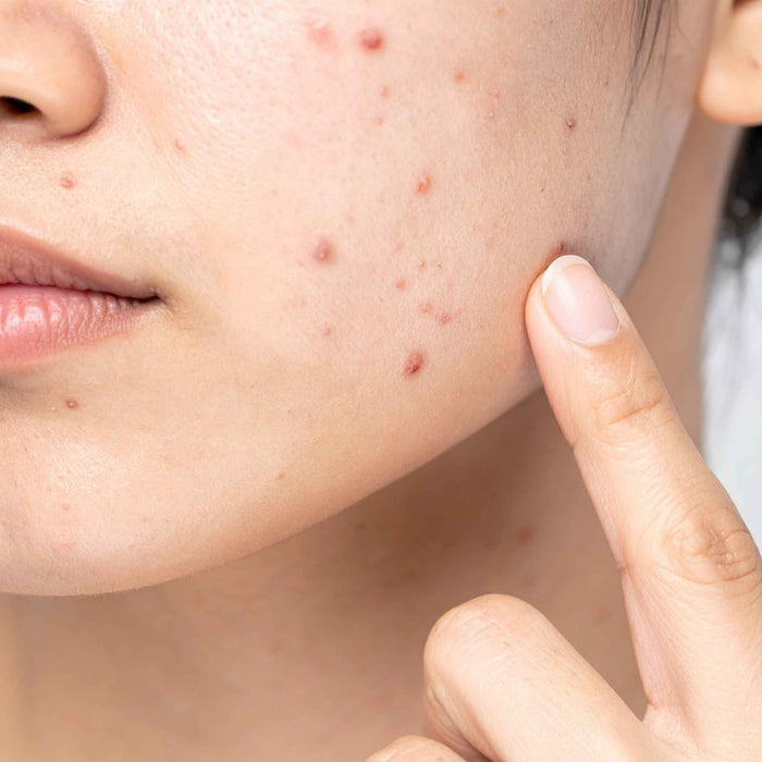 Does Silk Help Acne?